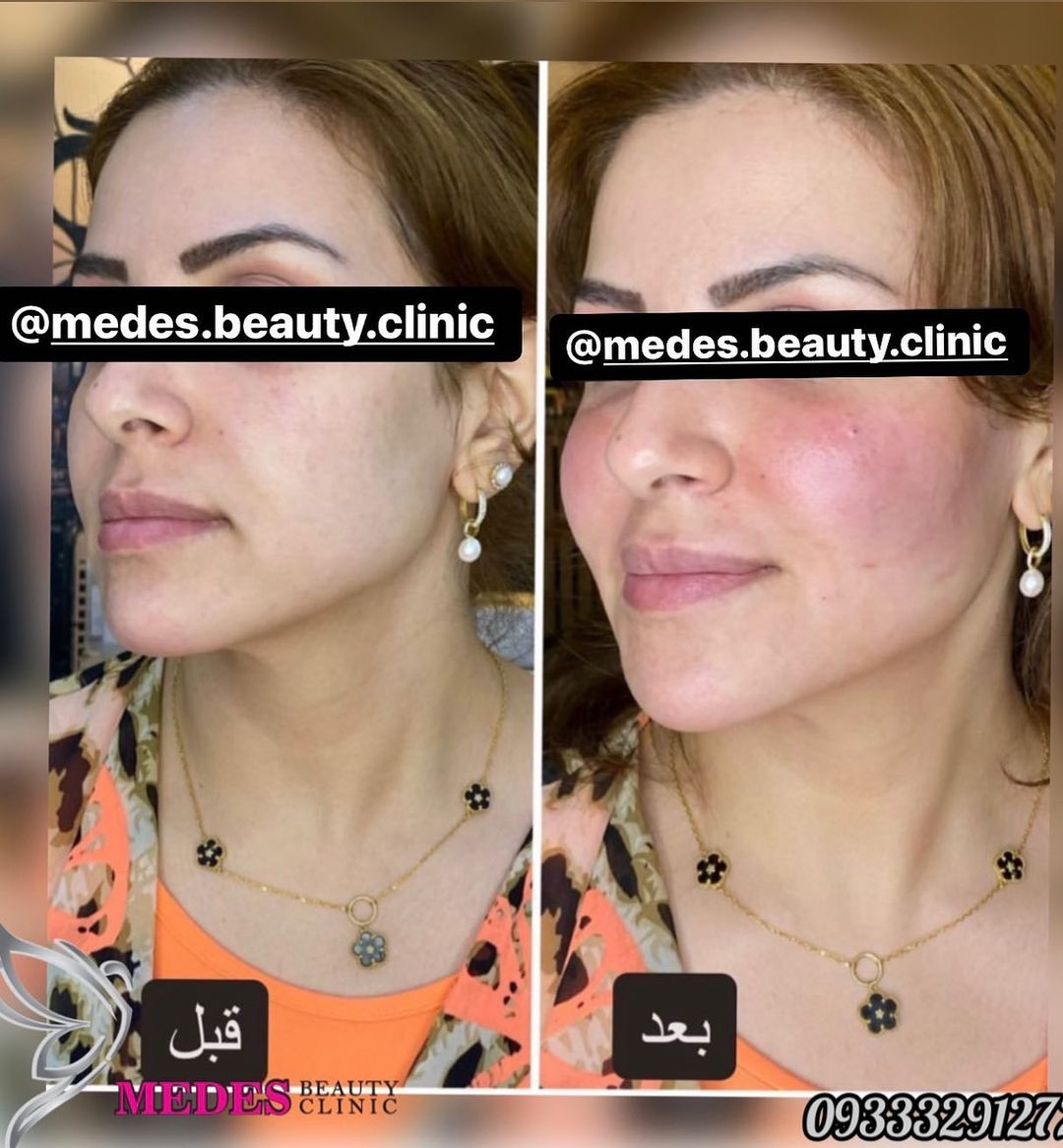 گالری زاویه سازی صورت